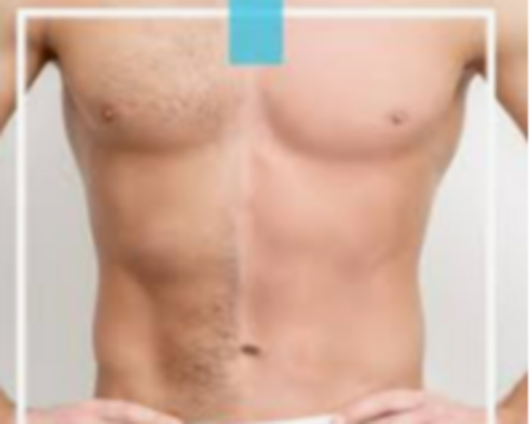 Depilación Láser pecho y abdomen (6 sesiones)