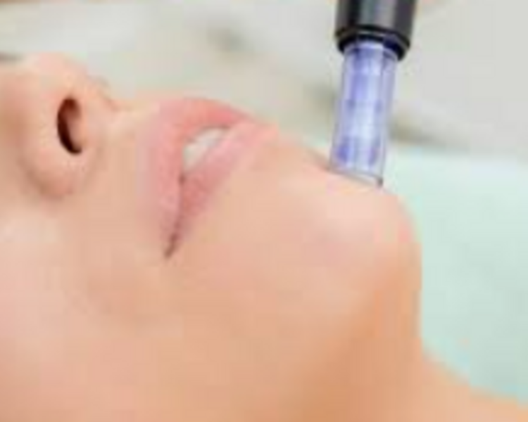 Rejuvenecimiento con metodo dermapen, Inducción de Colágeno, aminoácidos, ácido hialurónico, vitamina C + Limpieza facial.