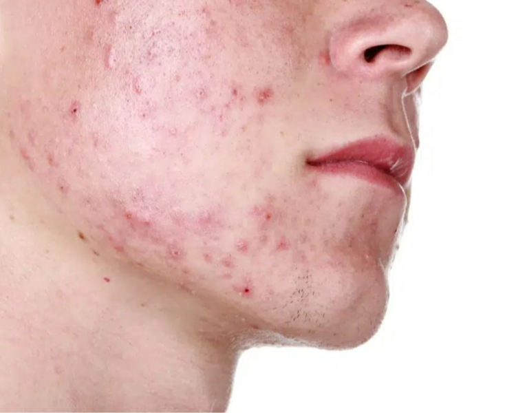 LIMPIEZA FACIAL PROFUNDA PARA ACNE