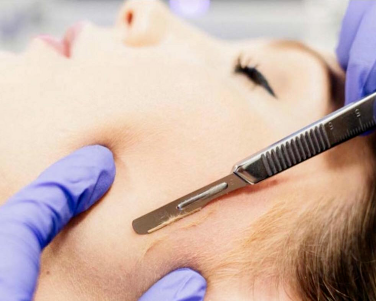 Dermaplaning 