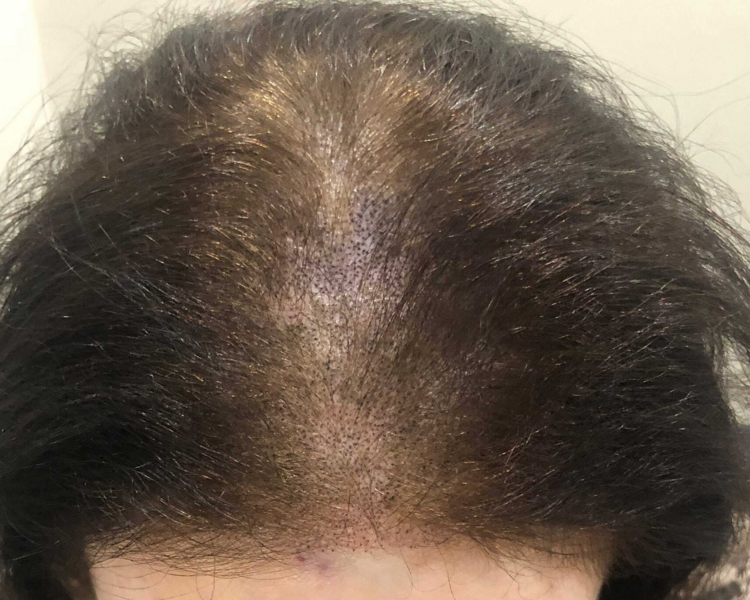 Retoque mensual micropigmentacion capilar