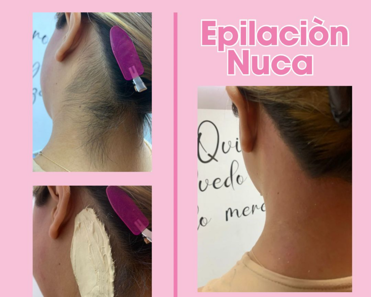 DEPILACIÓN NUCA