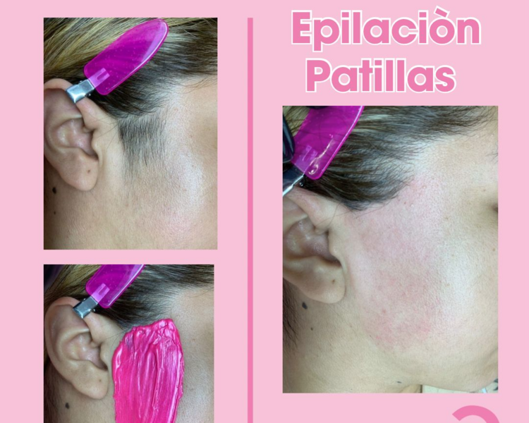 DEPILACIÓN PATILLAS