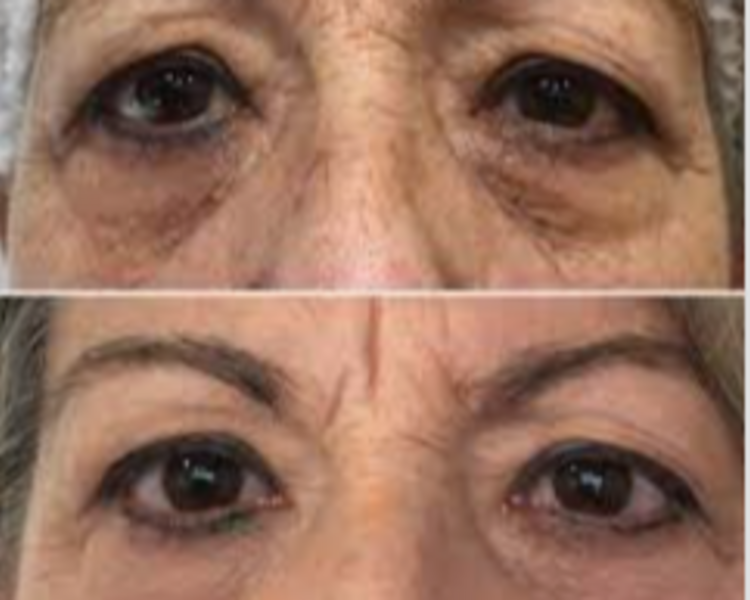 OJERAS REJUVENECIMIENTO CON ADN DE SALMON - CURENEX