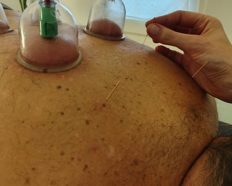 Masajes Descontracturantes + puncion seca