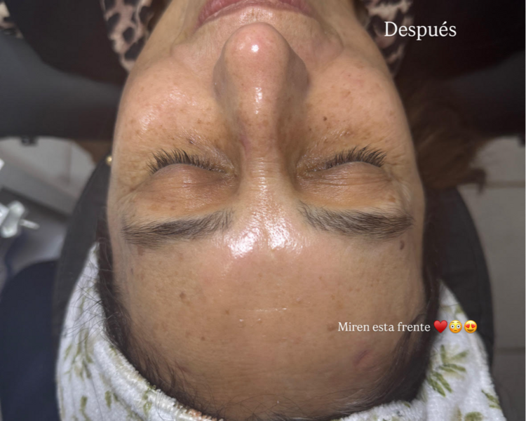 Masaje antiage Ultra Tense brasileño con radiofrecuencia