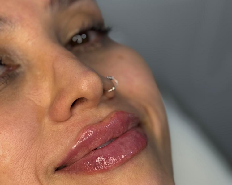 RELLENO DE LABIOS
