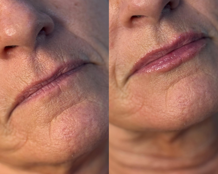 RELLENO DE LABIOS