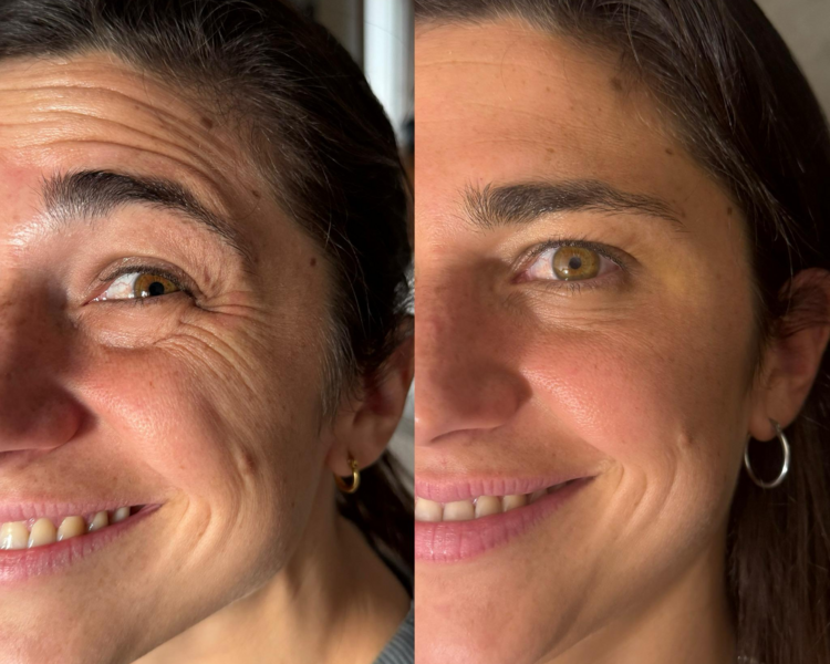 BOTOX