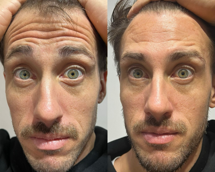 BOTOX