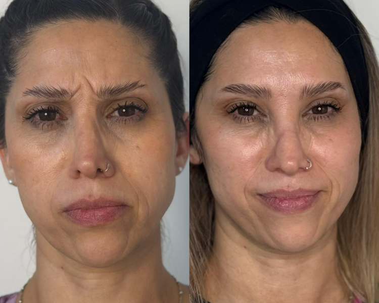 BOTOX