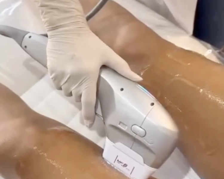HIFU Pierna entera + Gluteos + Subgluteos 
