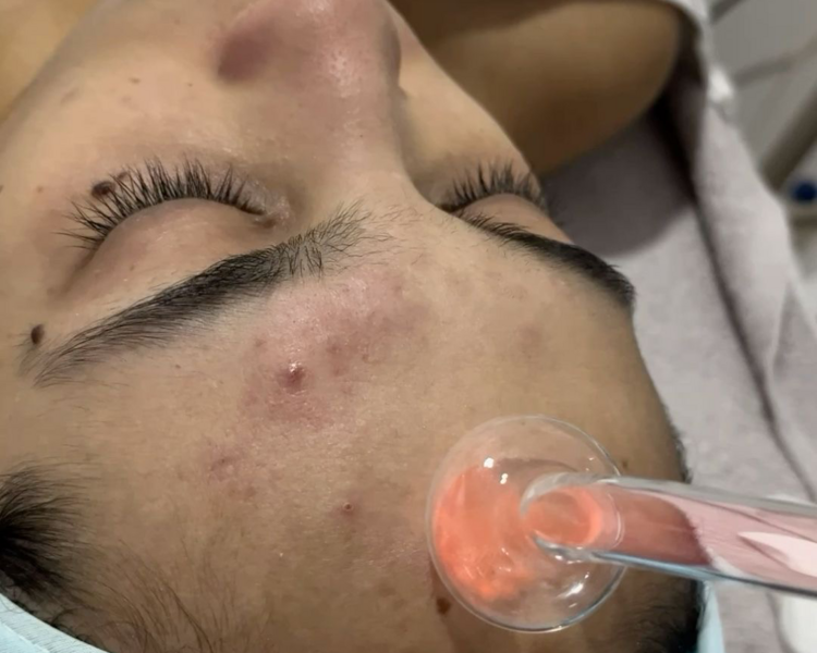 Limpieza facial profunda 
