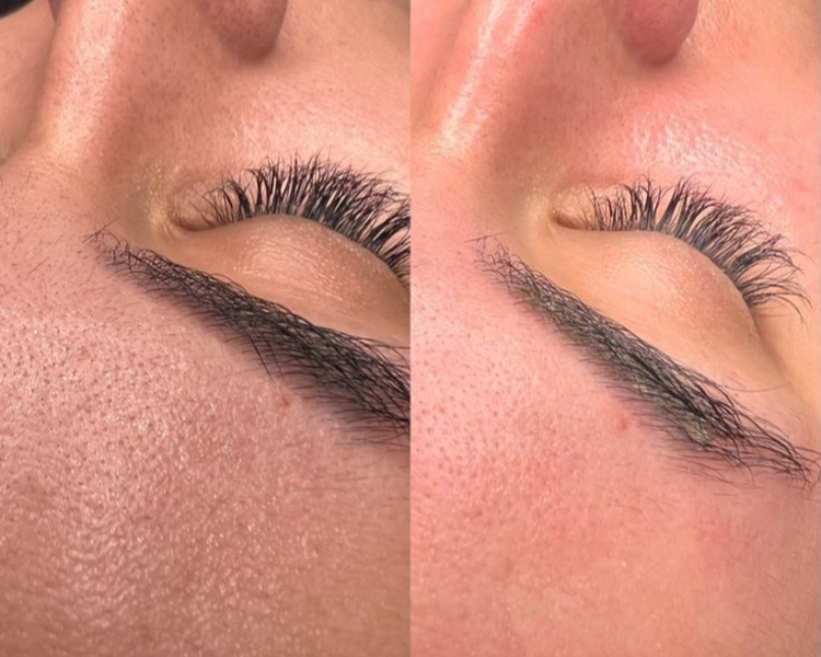 DERMAPLANING+Limpieza facial 