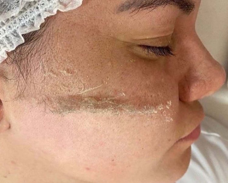 DERMAPLANING+Limpieza facial 