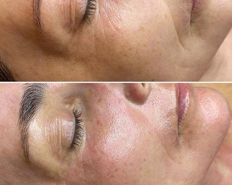 DERMAPEN+Limpieza facial
