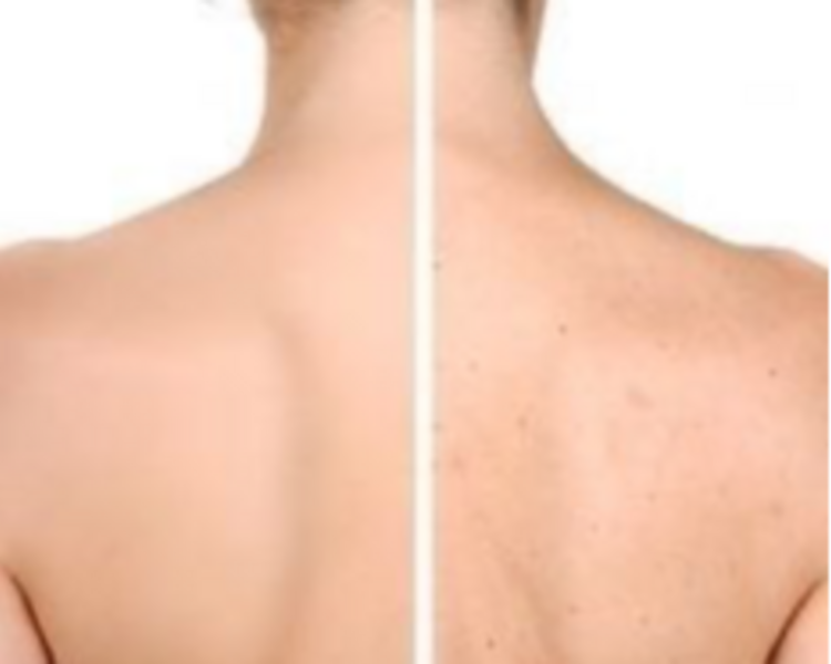 Limpieza corporal profunda (espalda/gluteos)