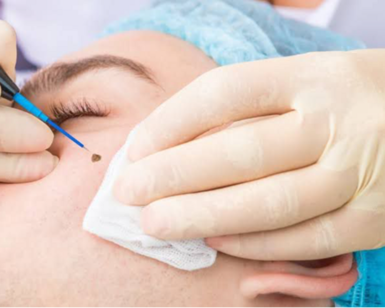 ELIMINACIÓN DE ACROCORDONES