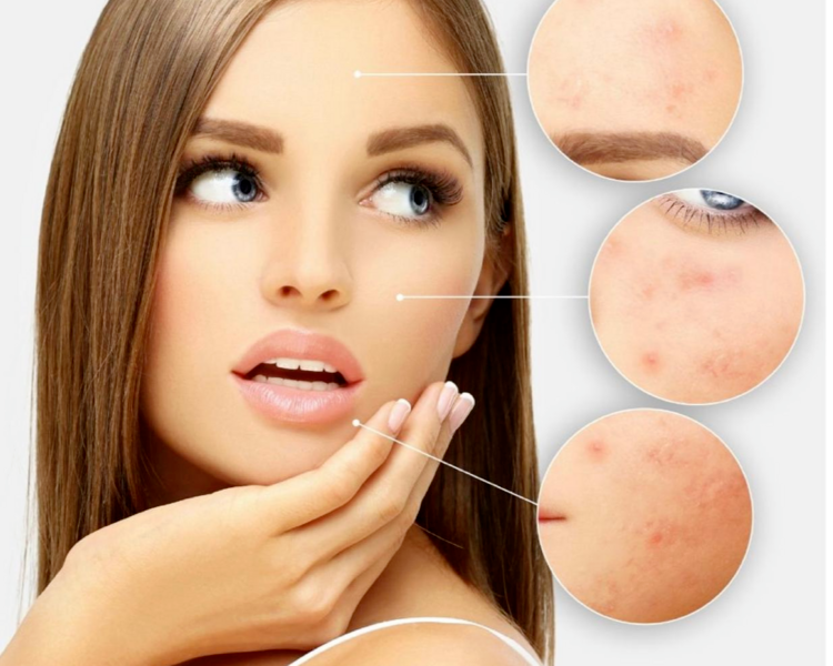 Higiene profunda facial o de cuello/escote mas peeling quimico