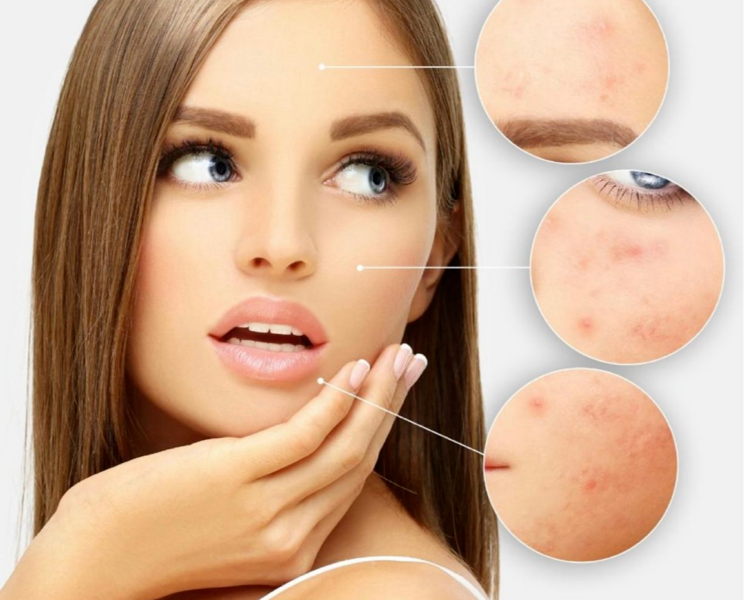 Higiene profunda facial o de cuello/escote mas peeling quimico