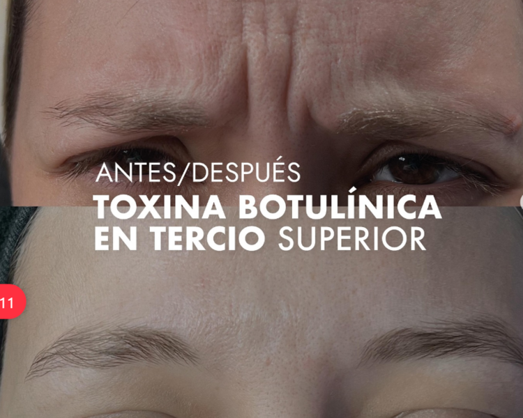 Toxina o Botox 2 zonas