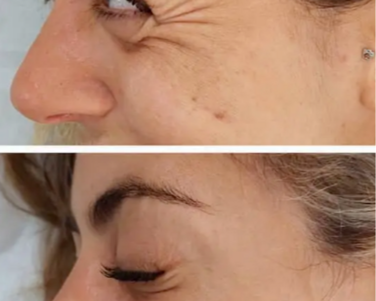 Toxina o Botox 3 zonas