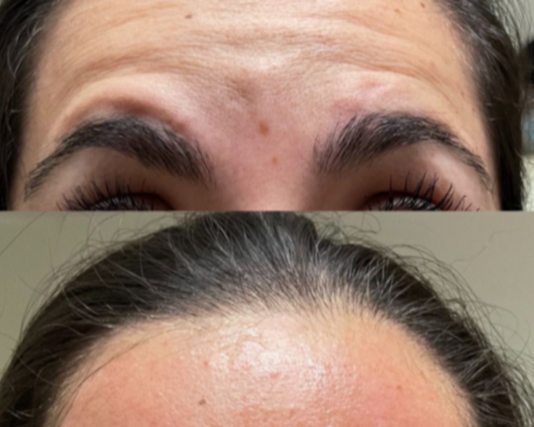 Toxina o Botox 3 zonas