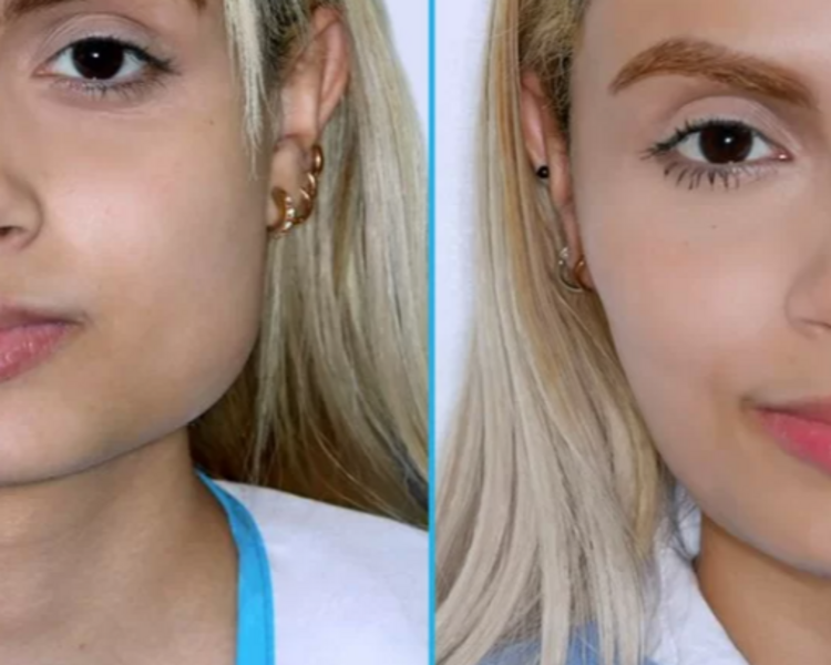 Toxina o Botox Bruxismo