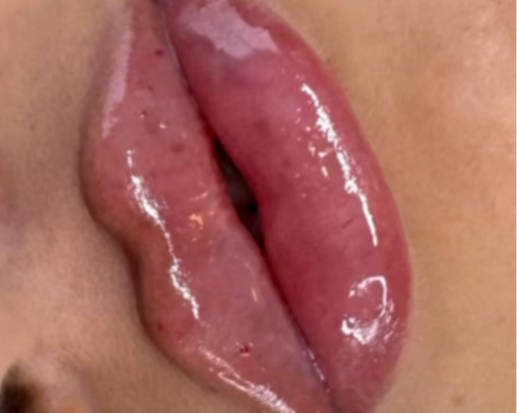 3ml Acido hialuronico