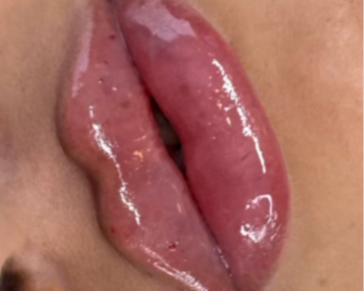 2ml Acido Hialuronico
