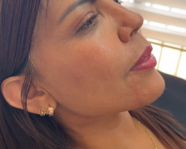 Mandíbula perfilado