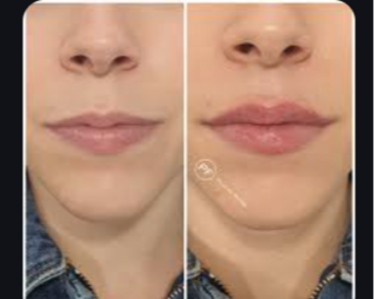 Labio Natural  1ml Acido hialuronico