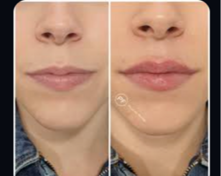 Labio Natural  1ml Acido hialuronico