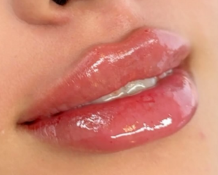 Labios Ruso o Bratz 2ml acido hialuronico