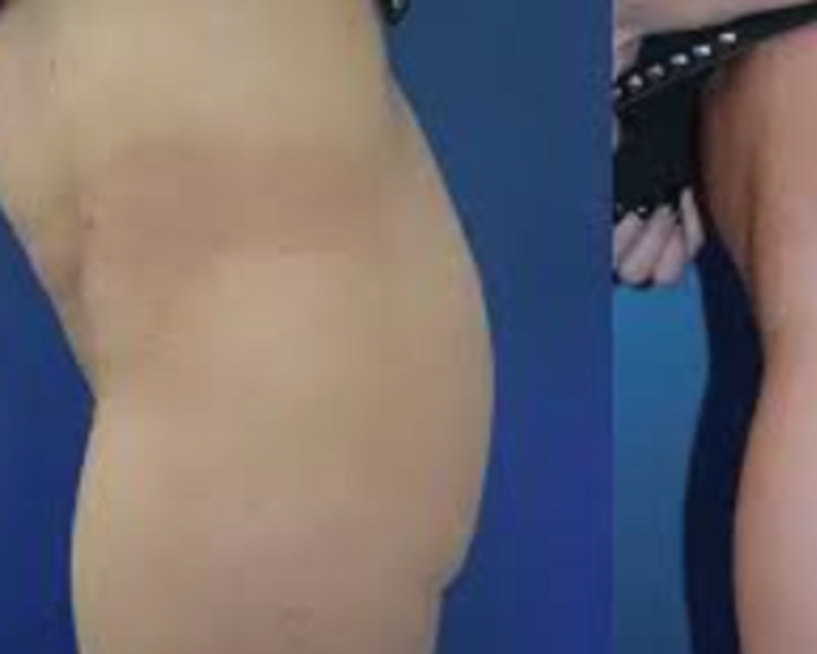Gluteos relleno aumento Acido Hialuronico