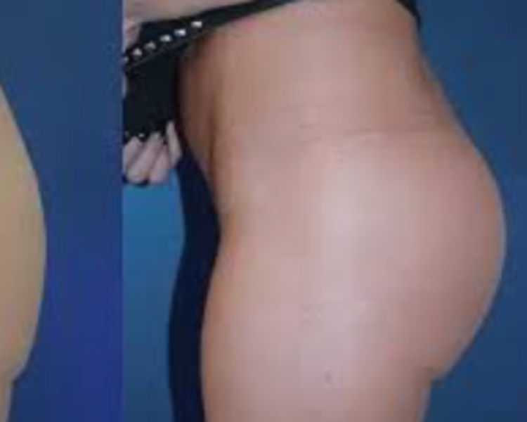Gluteos relleno aumento Acido Hialuronico