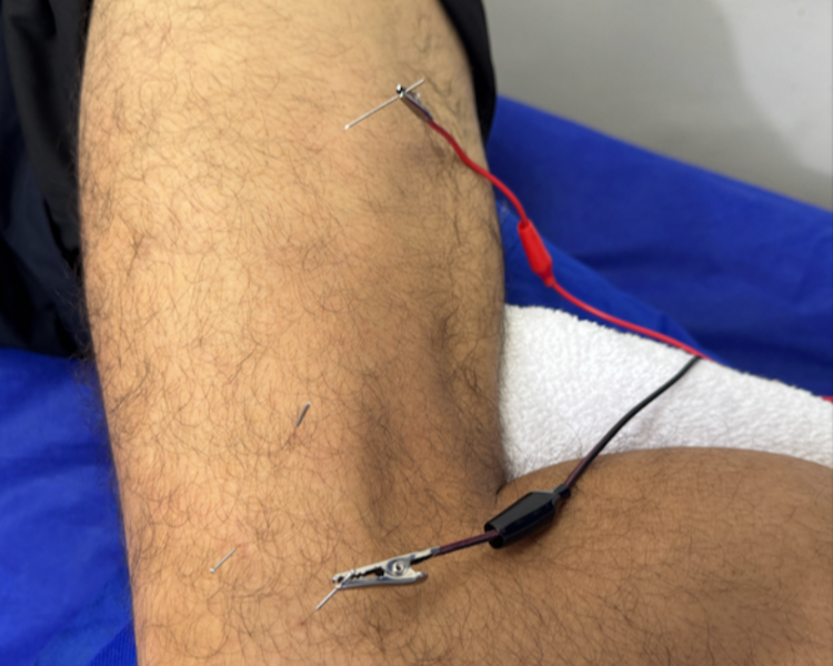 Terapia con Punción   Seca