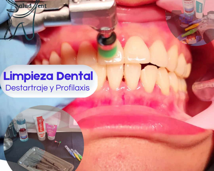  Destartaraje Supragingival / Subgingival Y Profilaxis