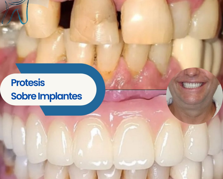 Implante Dental Unitario 