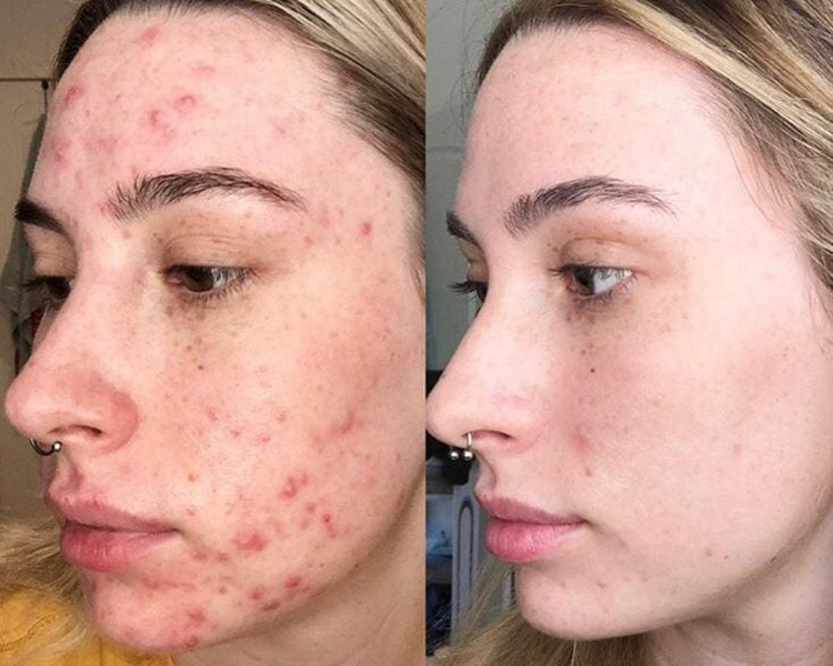 Peeling ACNE