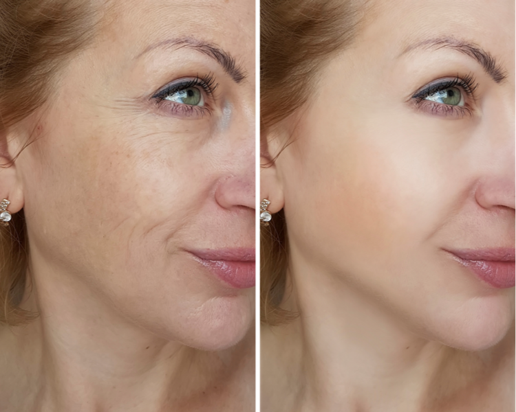 Peeling ANTIENVEJECIMIENTO