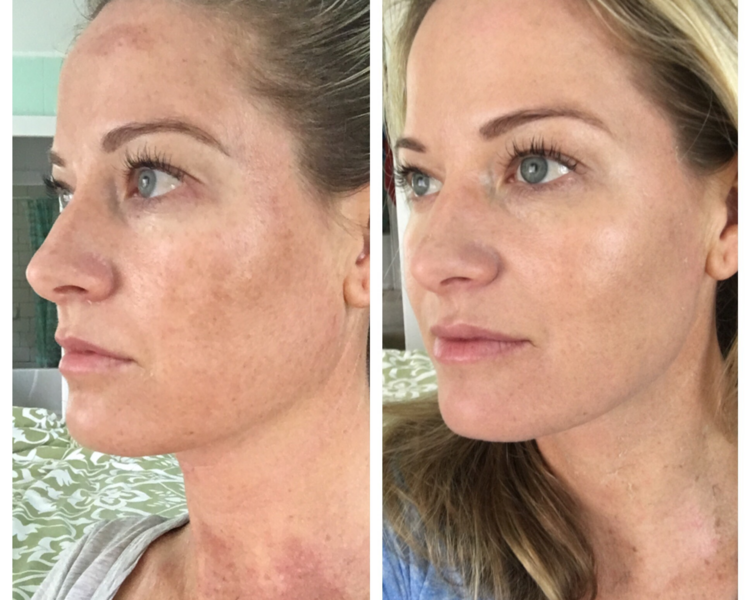 Peeling FULL ACTION CON TCA