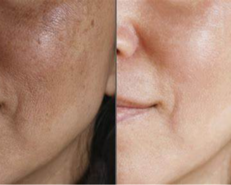 Peeling para MANCHAS