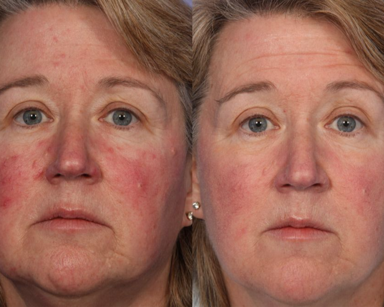 Peeling Rosacea