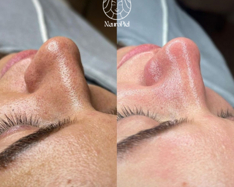 Limpieza Profunda – Hydrafacial