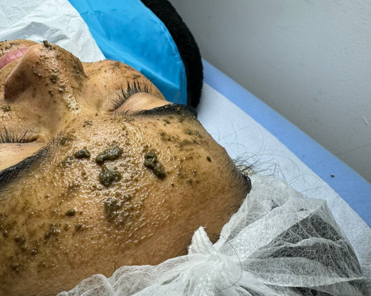 Peeling algas zena + fototerapia - Rostro