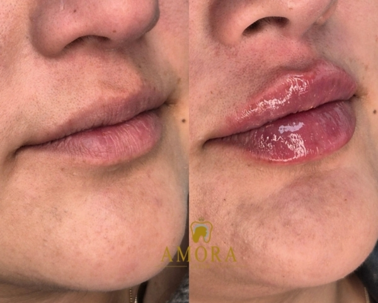 Labiomodelación – $180.000 (M. Hyafilia)/ $260.000 (M. Juvederm)