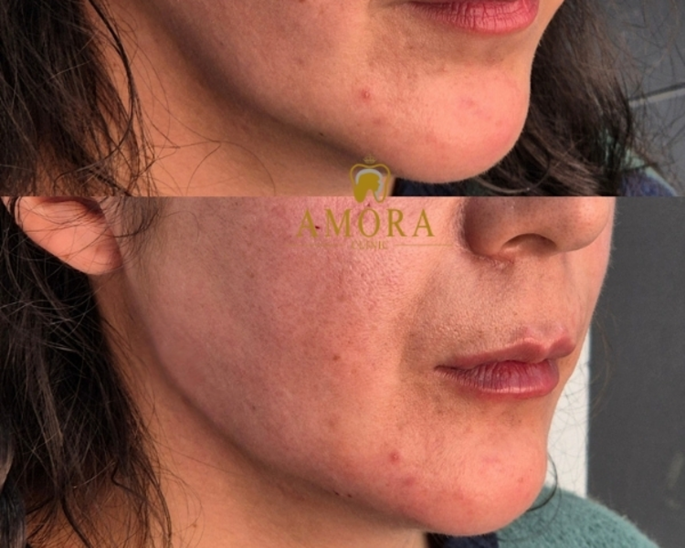 Perfilado Mandibular- $600.000 (10 ml- M. Hyafilia)