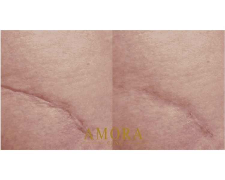 Relleno de cicatrices atróficas – $150.000 (M. Hyafilia) /$230.000 (M.Juvederm)