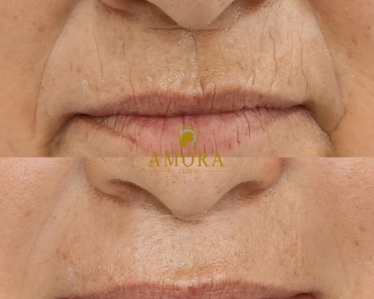 Relleno de arrugas código de barras – $216.000 (M. Viscoderm)